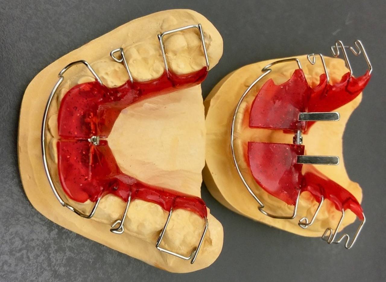 В Гродно врачи уже трижды принимали детей, проглотивших зубные пластины