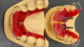 В Гродно врачи уже трижды принимали детей, проглотивших зубные пластины